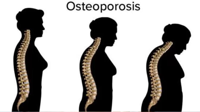 Mengenal Penyakit Osteoporosis dan Cara Mencegahnya – PAFI Muara Tebo